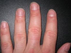 Диагностика по ногтям
